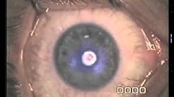 SynsLaser  cTen Laseroperasjon