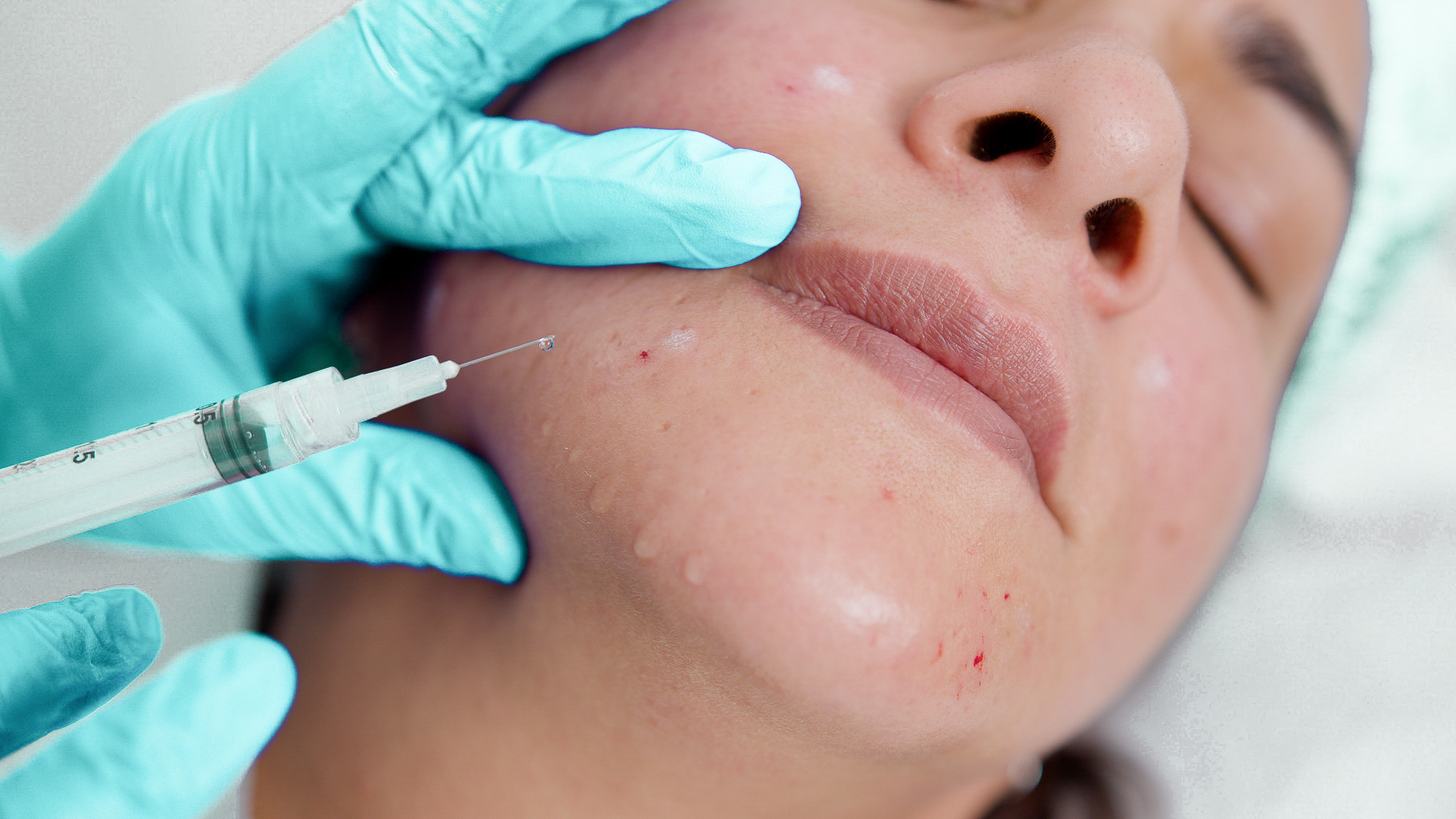 Mesotherapy Training