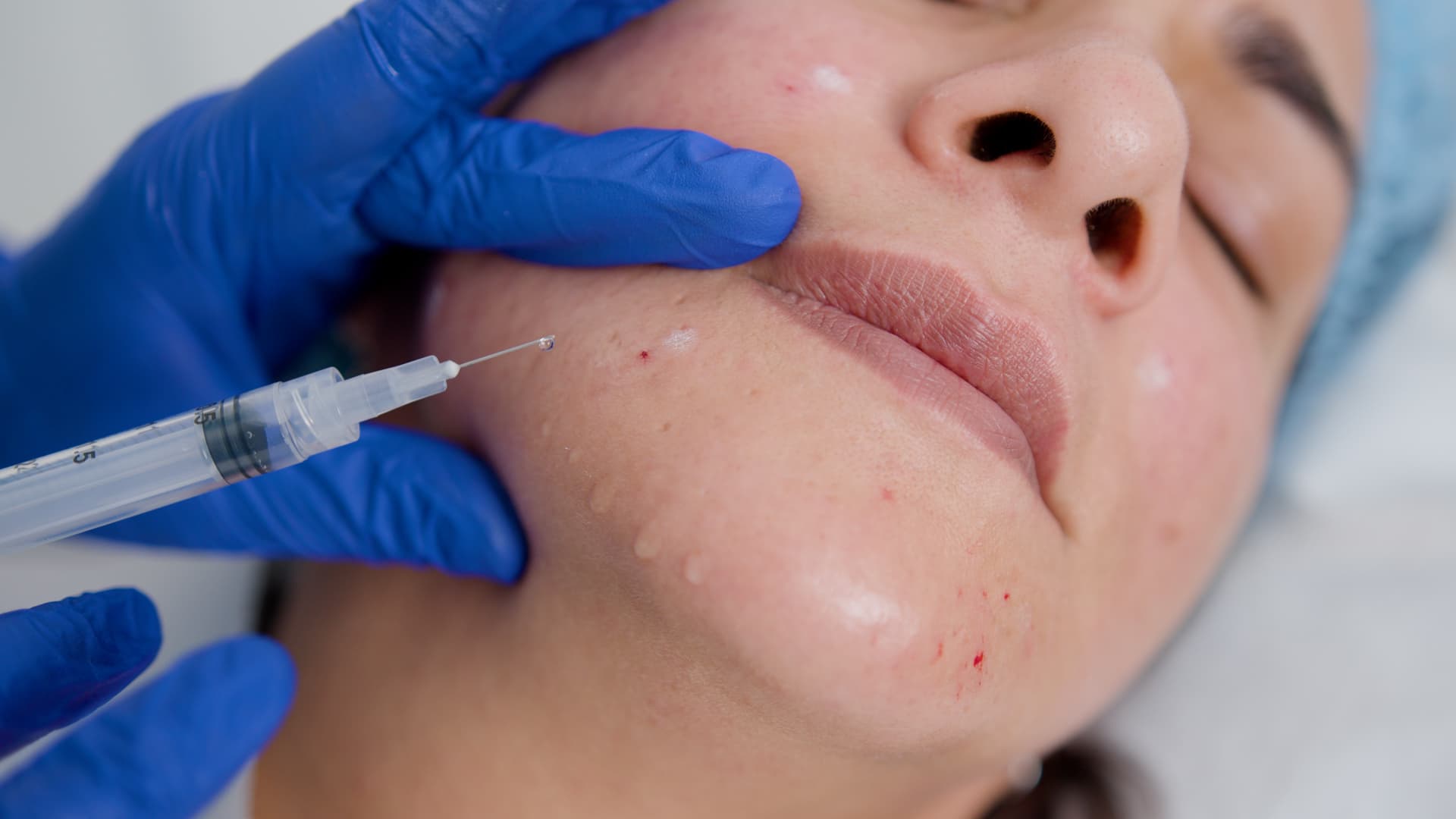 Online Mesotherapy training course