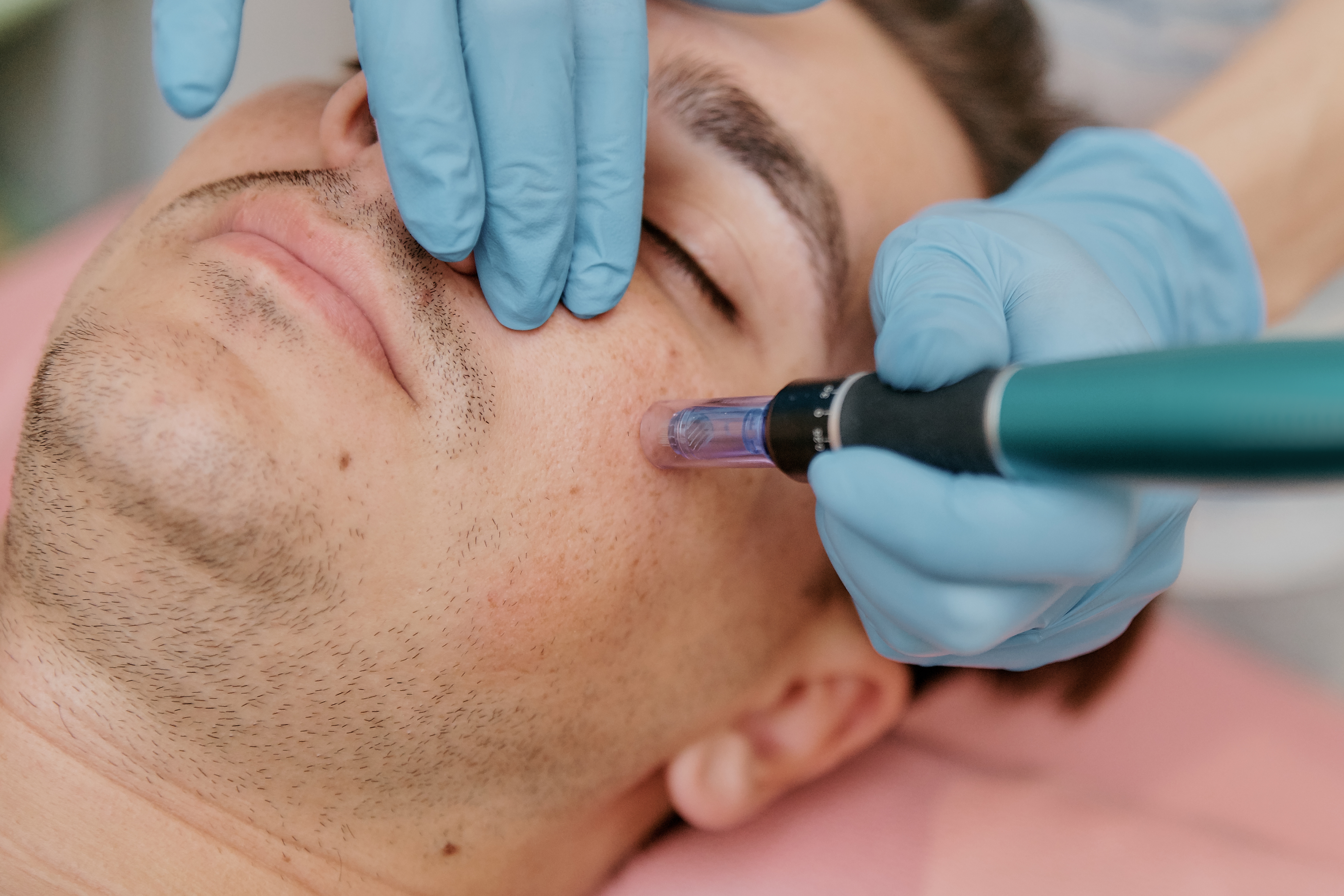Microneedling & Dermaroller Training