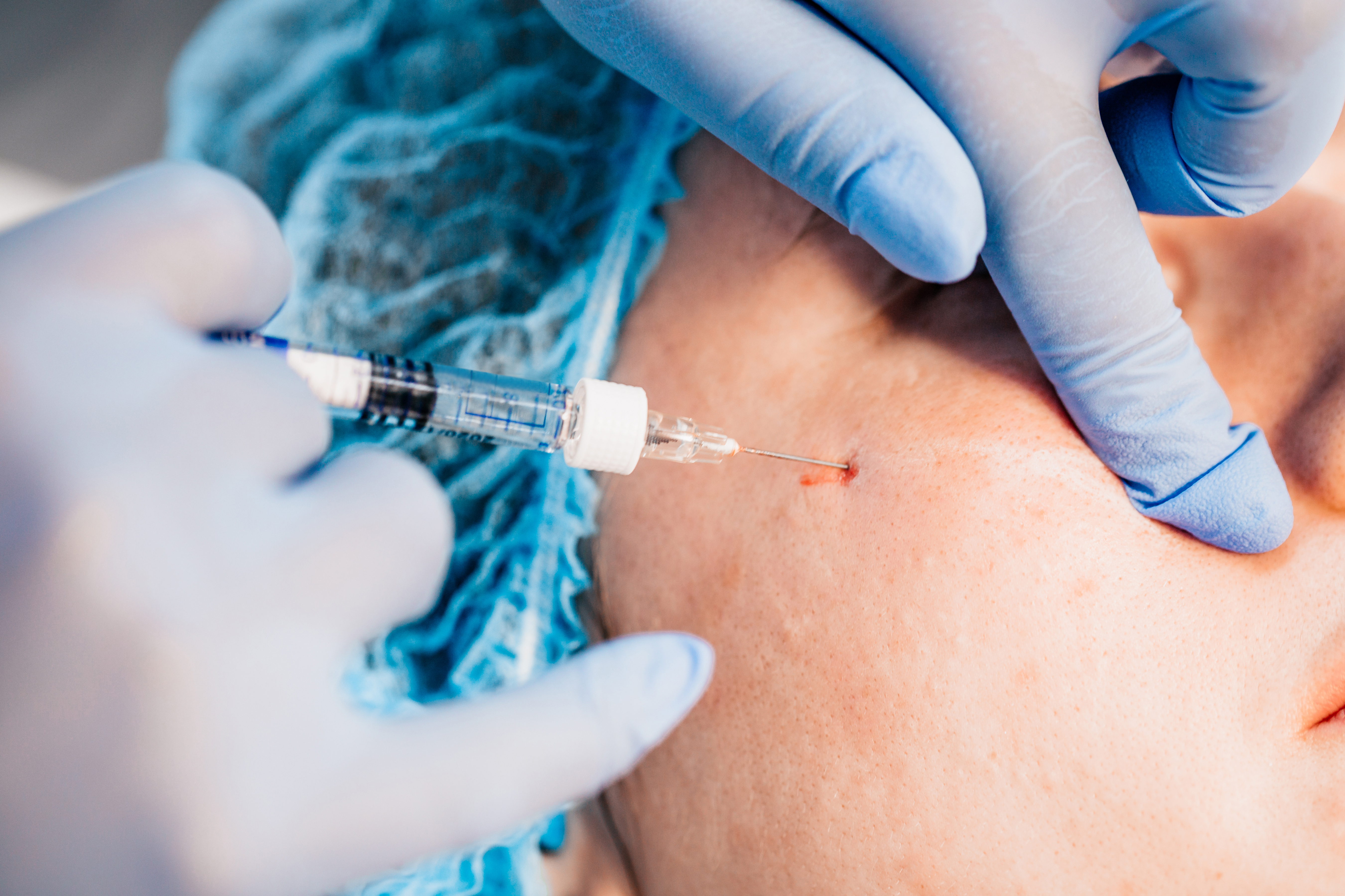 Cheeks, Jawline & Chin Cannula Dermal Fillers Masterclass