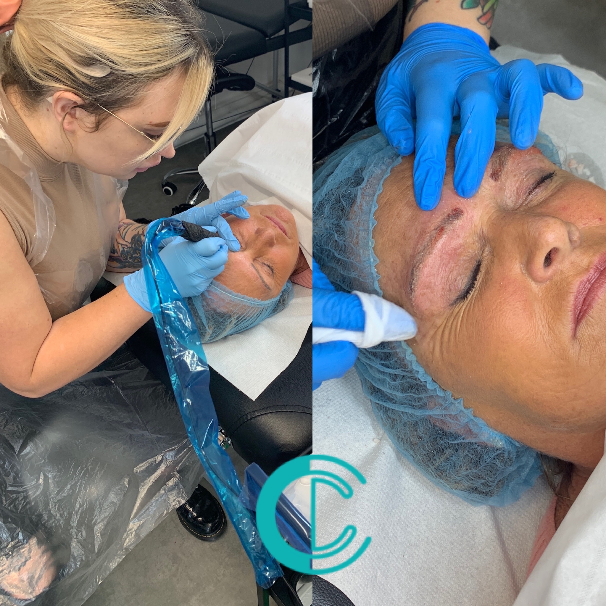Permanent Makeup Saline Removal & Correction