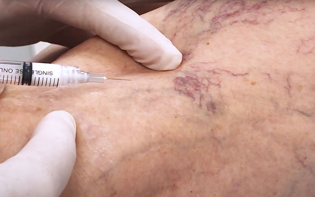 Online Sclerotherapy Theory CPD Course training course