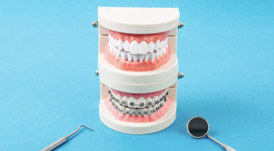 <strong>Dental Braces and Retainers: Different Types</strong>