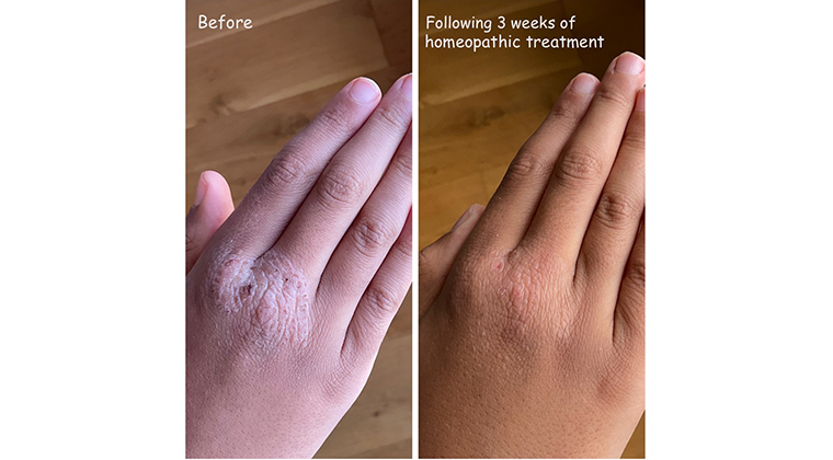 Homeopathy for Eczema