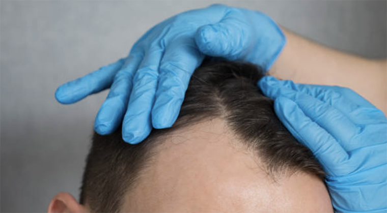 Post-op care- what to do the next 12 months of a hair transplant