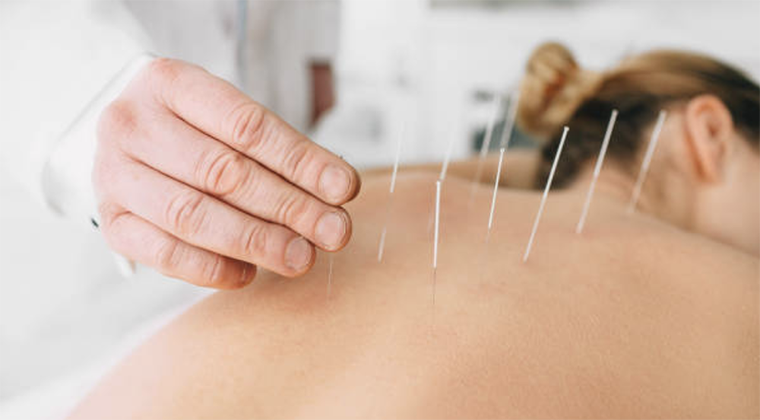 6 Reasons to Try Acupuncture in 2024