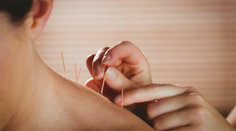 6 Reasons Why Women Should Try Acupuncture