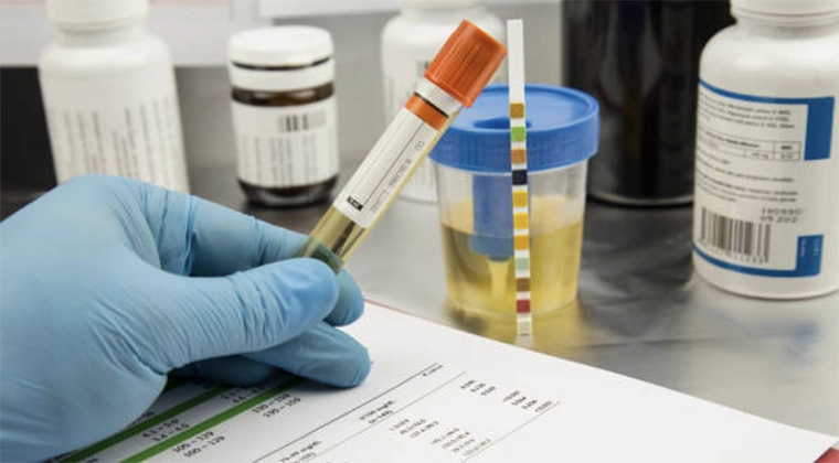 Urine Drug Test: A Comprehensive Guide To Monitor A Urine Drug Test