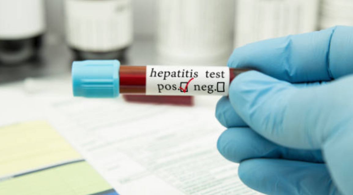 Hepatitis