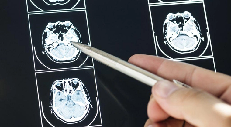 The Different Types of Brain Injury and Their Side Effects