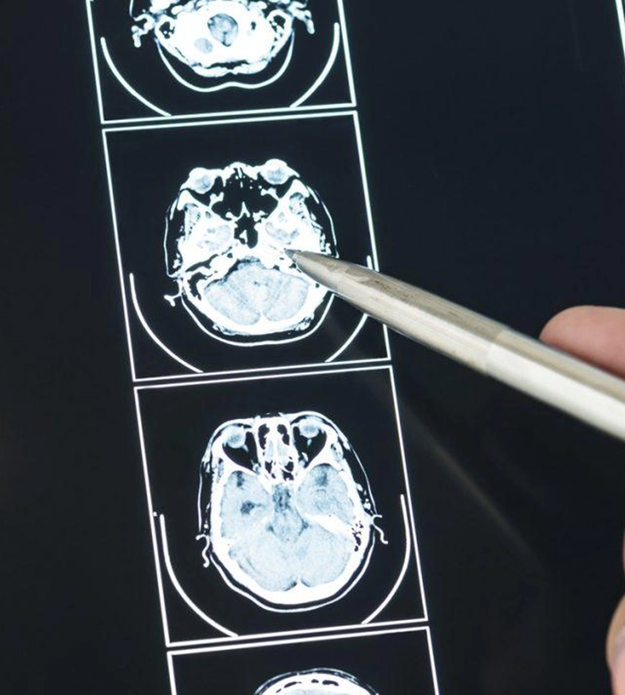 5 Common Myths About Brain Injury Claims Debunked