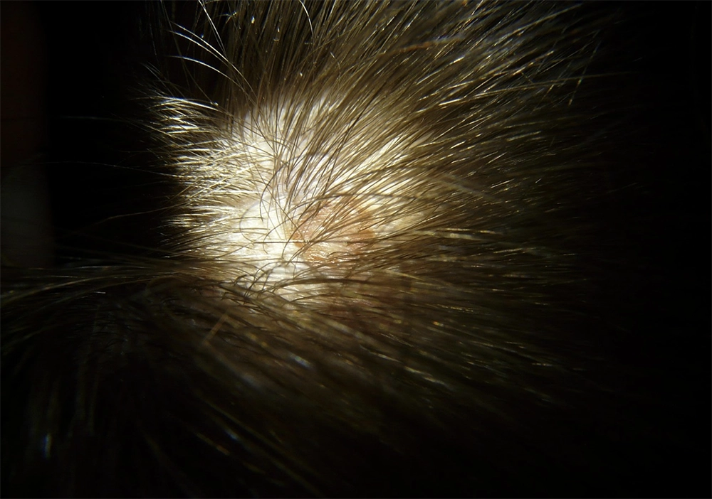 Hair Loss scalp health