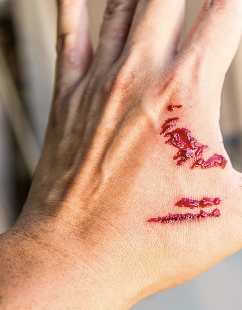 Dog Attack PTSD: How State and Local Laws Impact Mental Health Recovery 