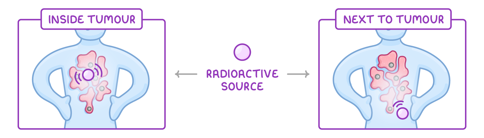 A circle labelled radioactive source in the middle, arrows leading to two torsos: in the panel headed inside tumour it sits within the pink tumour, and in next to tumour just below it.