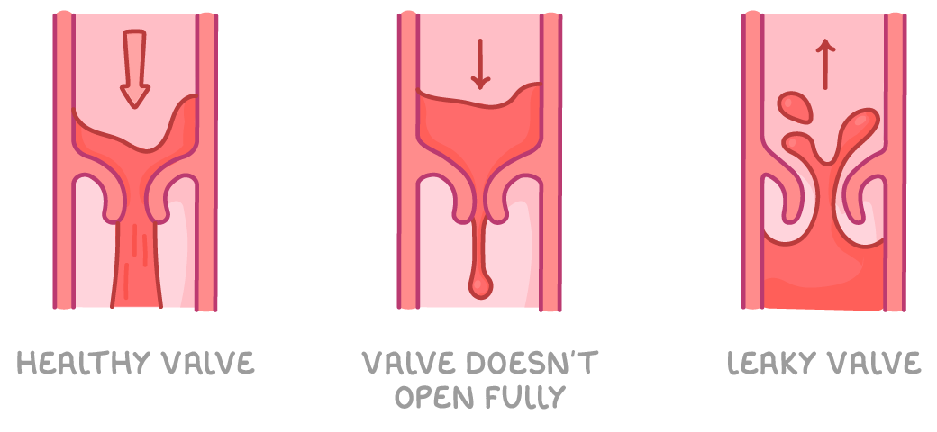 Three views of a valve inside a vessel: healthy valve with blood flowing down through it, valve doesn't open fully with only a narrow gap, and leaky valve with blood passing back up.