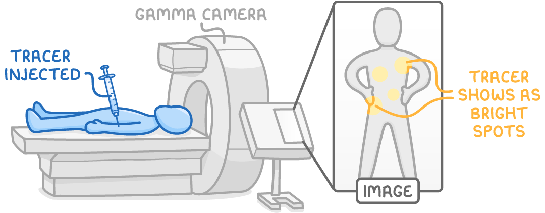 A patient lies on a bed at a ring scanner labelled gamma camera, with a syringe labelled tracer injected, beside a body outline with yellow dots labelled tracer shows as bright spots.