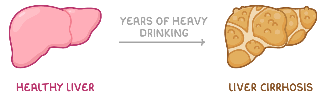 A smooth pink liver labelled healthy liver on the left and a lumpy, scarred orange liver labelled liver cirrhosis on the right, joined by an arrow labelled years of heavy drinking.