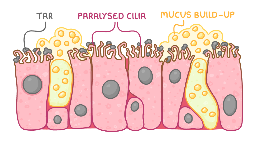 A row of airway lining cells with bent, flattened cilia, grey specks and thick yellow mucus piled on top, labelled tar, paralysed cilia and mucus build-up.