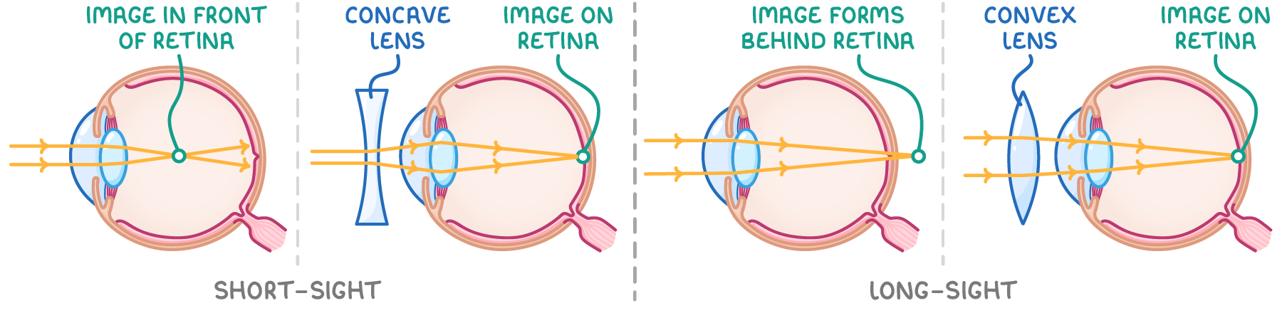 Four side-view eyes with light rays: short-sight, image in front of retina then a concave lens giving image on retina; long-sight, image forms behind retina then a convex lens giving image on retina.