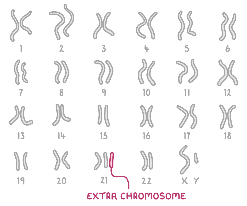 A karyotype of chromosome pairs numbered 1 to 22 plus X and Y, with three chromosomes at number 21 instead of two, the third one pink and labelled extra chromosome.