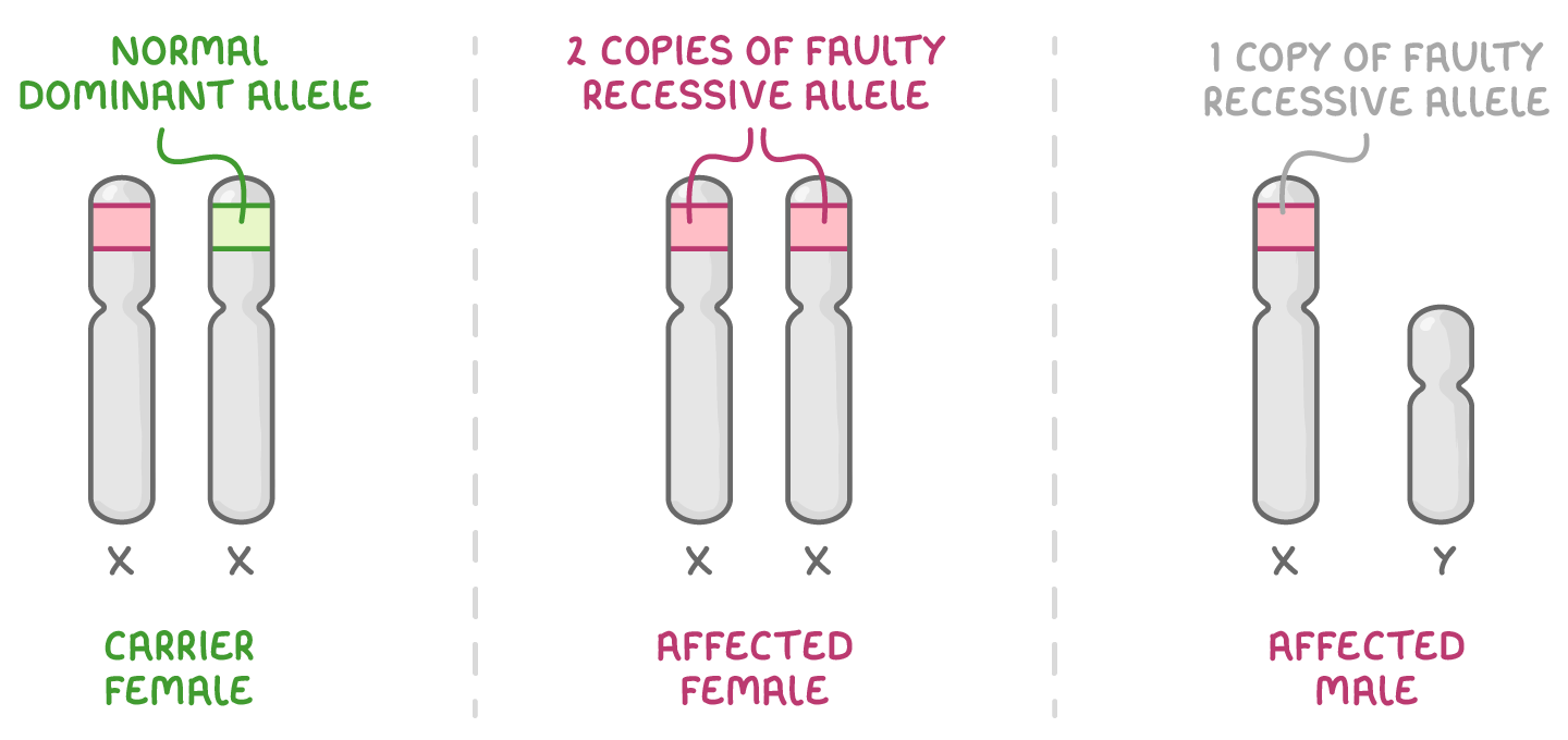Three panels: a carrier female, one X carrying the normal dominant allele; an affected female with 2 copies of faulty recessive allele; an affected male, one X plus a shorter Y.