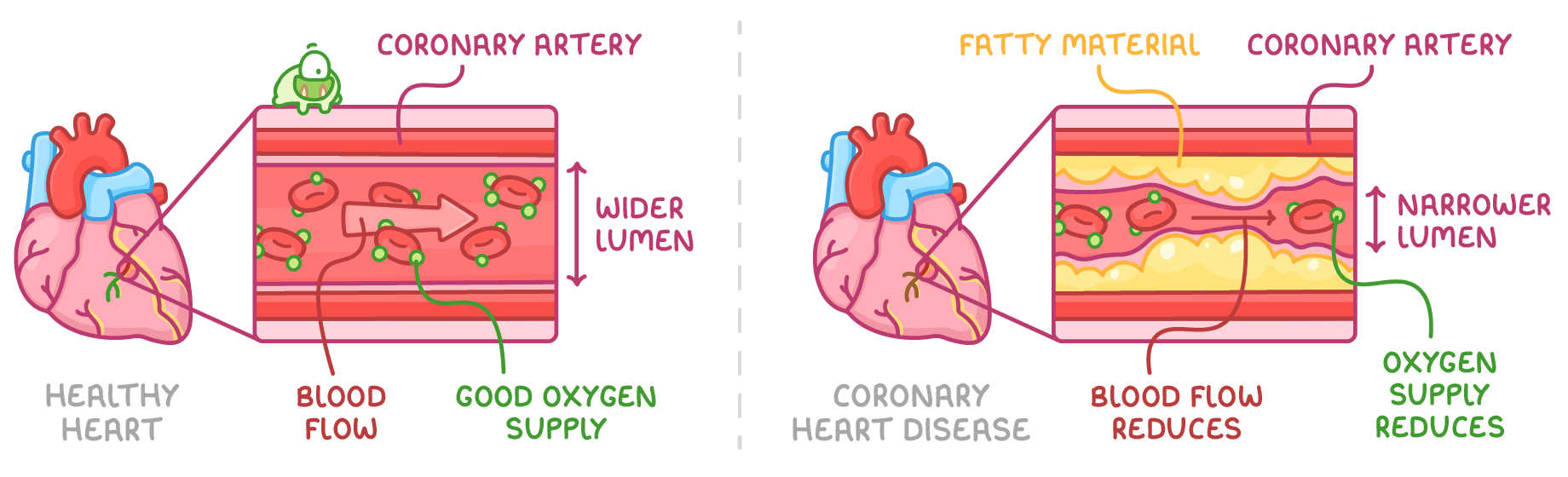 Two hearts side by side, each with a close-up of a coronary artery: one labelled healthy heart, wider lumen and good oxygen supply, the other coronary heart disease, fatty material and narrower lumen.