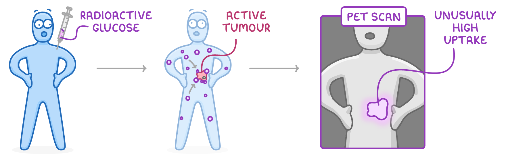 Three panels: a patient injected with a syringe labelled radioactive glucose, then dots gathering at a pink active tumour, then a grey PET scan with a bright patch labelled unusually high uptake.