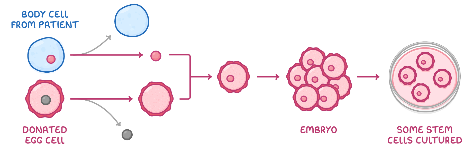 A cell labelled body cell from patient gives up its nucleus, a donated egg cell loses its own, the two combine, then a cluster labelled embryo, then a dish labelled some stem cells cultured.