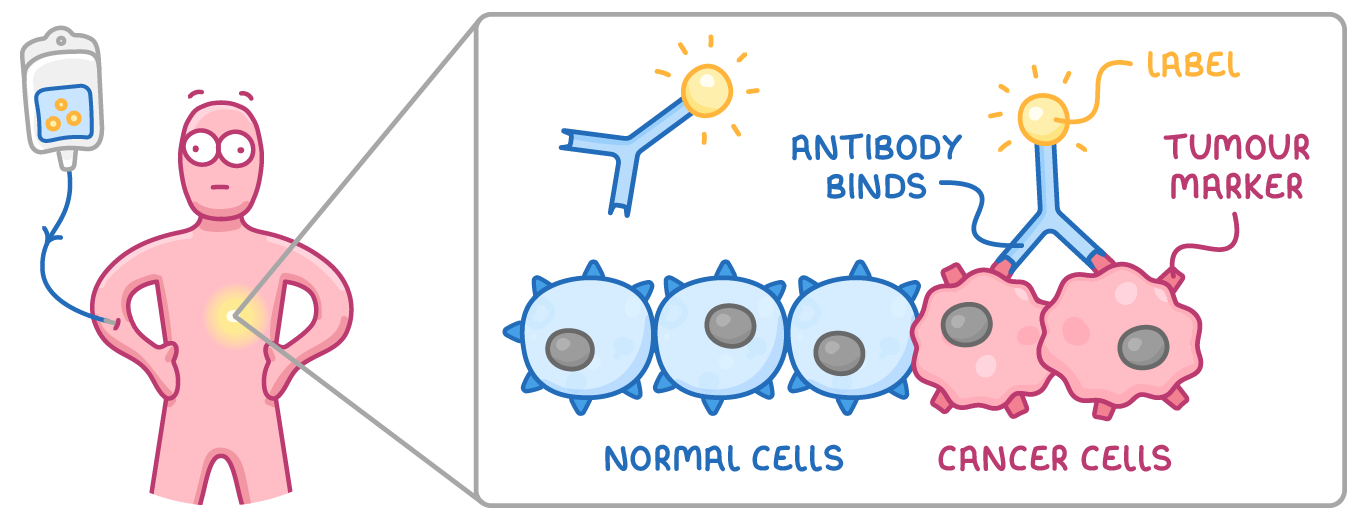 A person on a drip with a glowing spot in the abdomen, and a close-up where a Y-shaped antibody carrying a glowing label binds a tumour marker on cancer cells, next to normal cells.