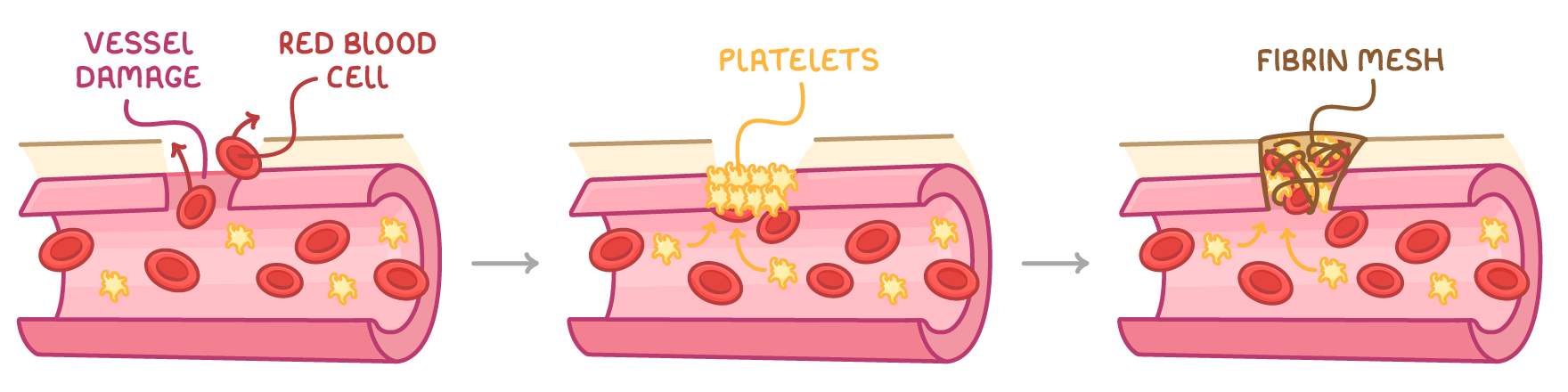 Three stages of a cut blood vessel: the break labelled vessel damage and red blood cell, yellow platelets clumping in the gap labelled platelets, and a criss-cross plug labelled fibrin mesh.