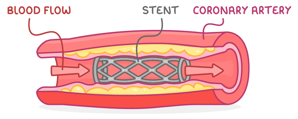 A cut-open coronary artery with yellow fatty deposits along its walls and a wire mesh tube holding it open, arrows showing blood passing through, labelled blood flow, stent and coronary artery.
