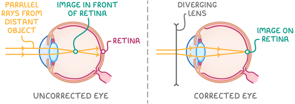 Two eye cross-sections labelled uncorrected eye, where parallel rays from a distant object meet in front of the retina, and corrected eye, where a diverging lens makes them meet on the retina.