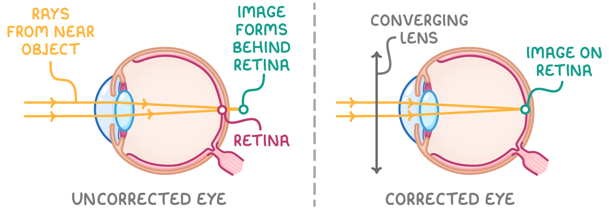 Two eye cross-sections labelled uncorrected eye, where rays from a near object head for a focus behind the retina, and corrected eye, where a converging lens brings them to a focus on the retina.