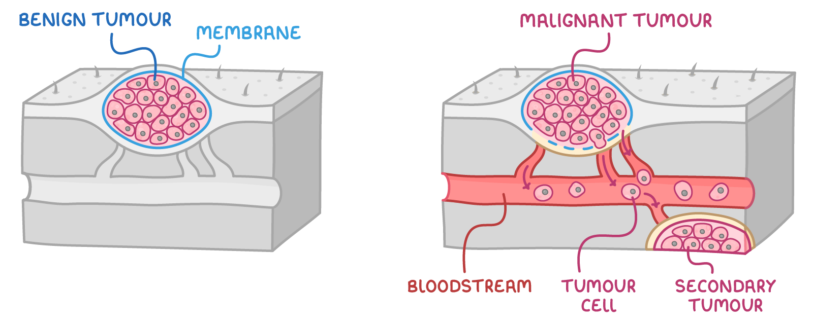 Two blocks of tissue side by side: a rounded mass labelled benign tumour held inside a membrane, and a malignant tumour whose cells escape into a vessel labelled bloodstream, tumour cell and secondary tumour.