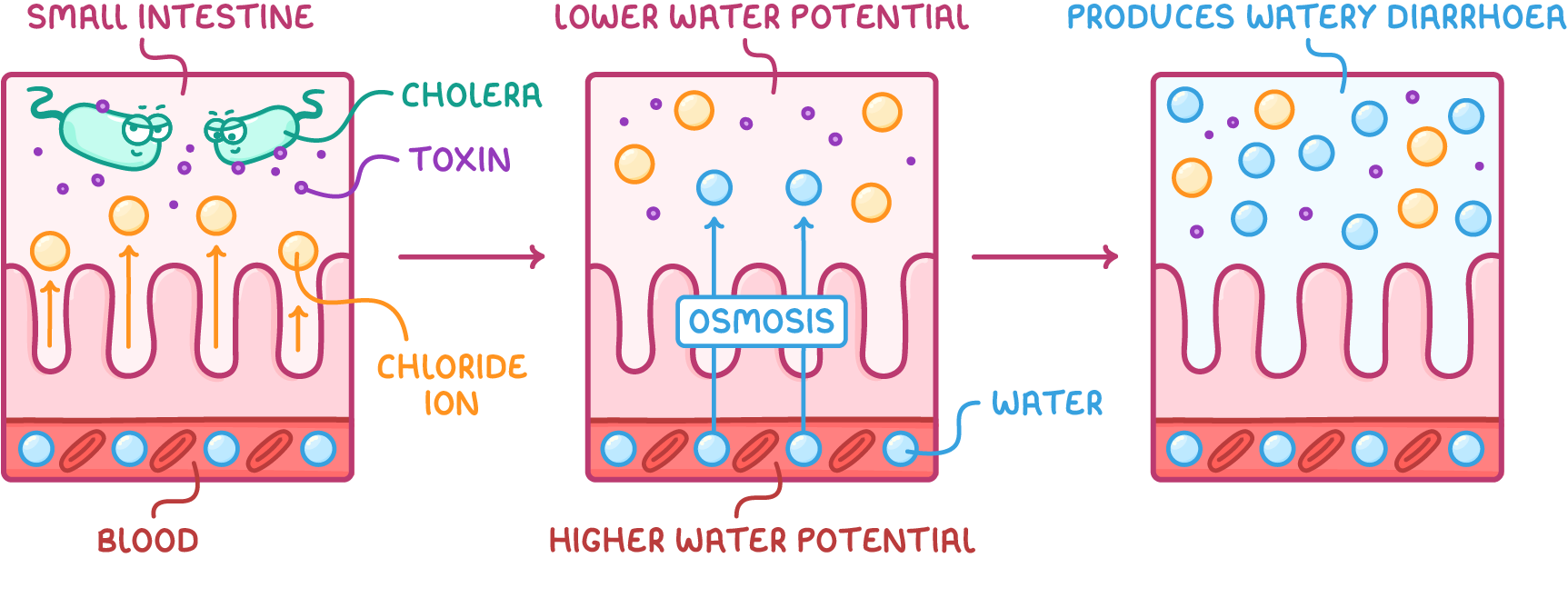 Three panels of the small intestine wall above a blood layer: cholera bacteria releasing toxin, chloride ions moving into the gut, then water rising by osmosis, labelled lower water potential and produces watery diarrhoea.