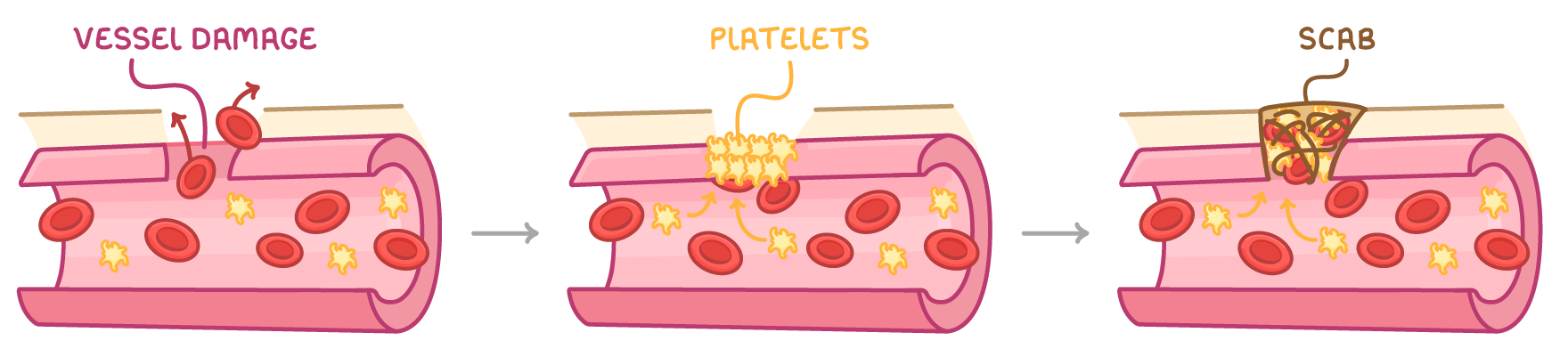 Three stages of a cut blood vessel: the break labelled vessel damage, yellow platelets clumping in the gap labelled platelets, and a brown plug across it labelled scab.