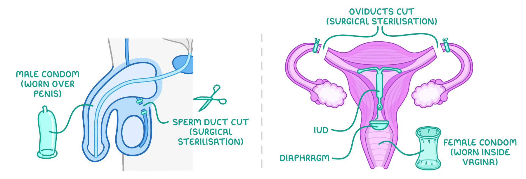 A male side view labelled male condom and sperm duct cut (surgical sterilisation), beside a female front view labelled oviducts cut (surgical sterilisation), IUD, diaphragm and female condom.
