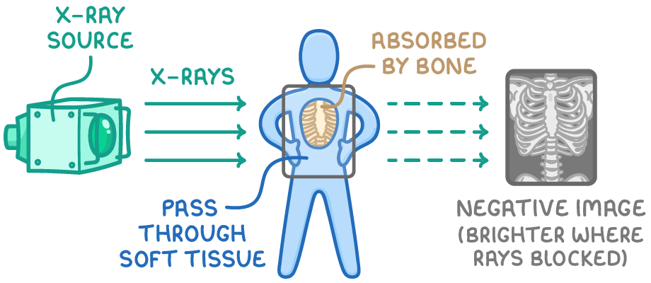 A green box labelled X-ray source fires green arrows through a standing figure onto a grey picture of ribs, with labels X-rays, pass through soft tissue, absorbed by bone and negative image.