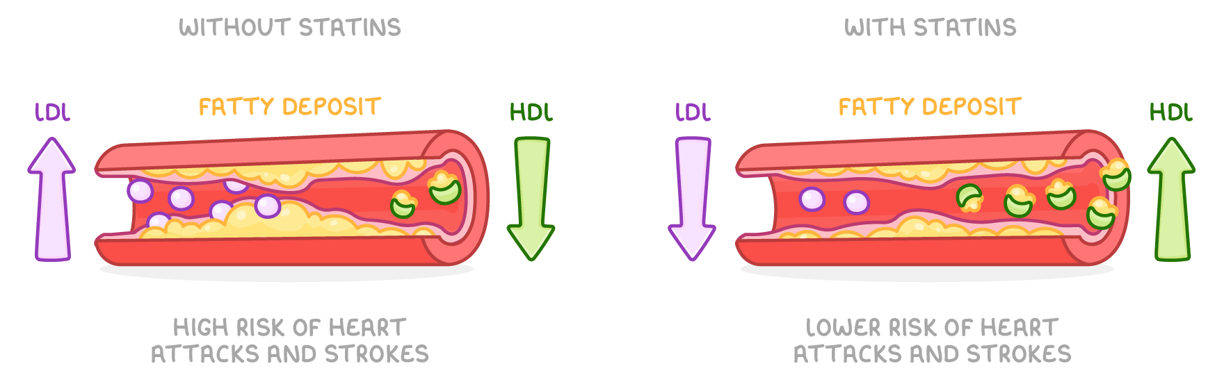 Two arteries lined with fatty deposit, one labelled without statins with LDL rising, HDL falling and high risk of heart attacks and strokes, the other with statins showing the reverse and lower risk.