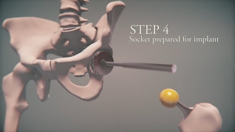 Hip replacement Operation