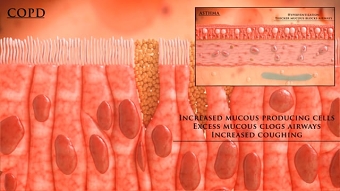 3D MEDICAL ASTHMA ANIMATION