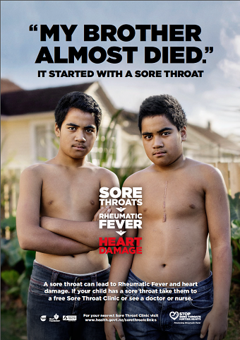 Rheumatic Fever