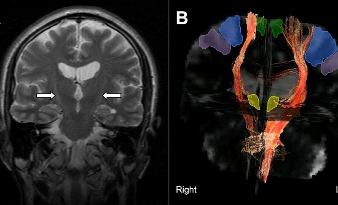 ALS- Clinical Signals of a “Synaptic Regenerative” Approach!