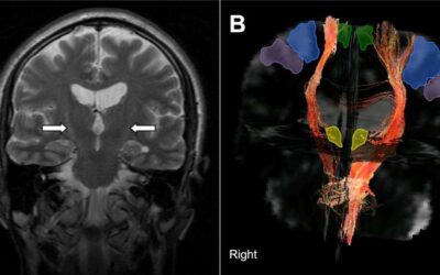 ALS- Clinical Signals of a “Synaptic Regenerative” Approach!