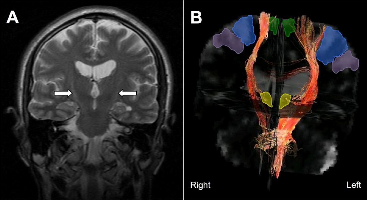 casereports-2013-October-2013—F1.large Scientific illustration of neurons and synapses representing SPG302’s regenerative approach for ALS treatment