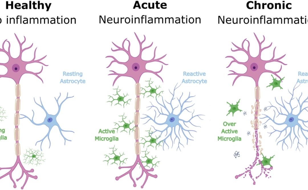 MRI Study Links Inflammation in Brain Reward Centre to Depression Severity