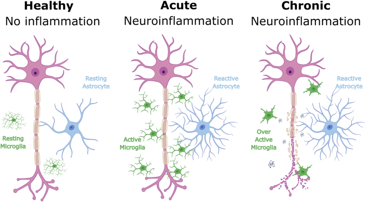 MRI-Study-depression-jpg Figure 1. Cellular changes in response to varying degrees of inflammation. The figure illustrates the progression of neuroinflammation from a healthy state to acute and chronic inflammation.