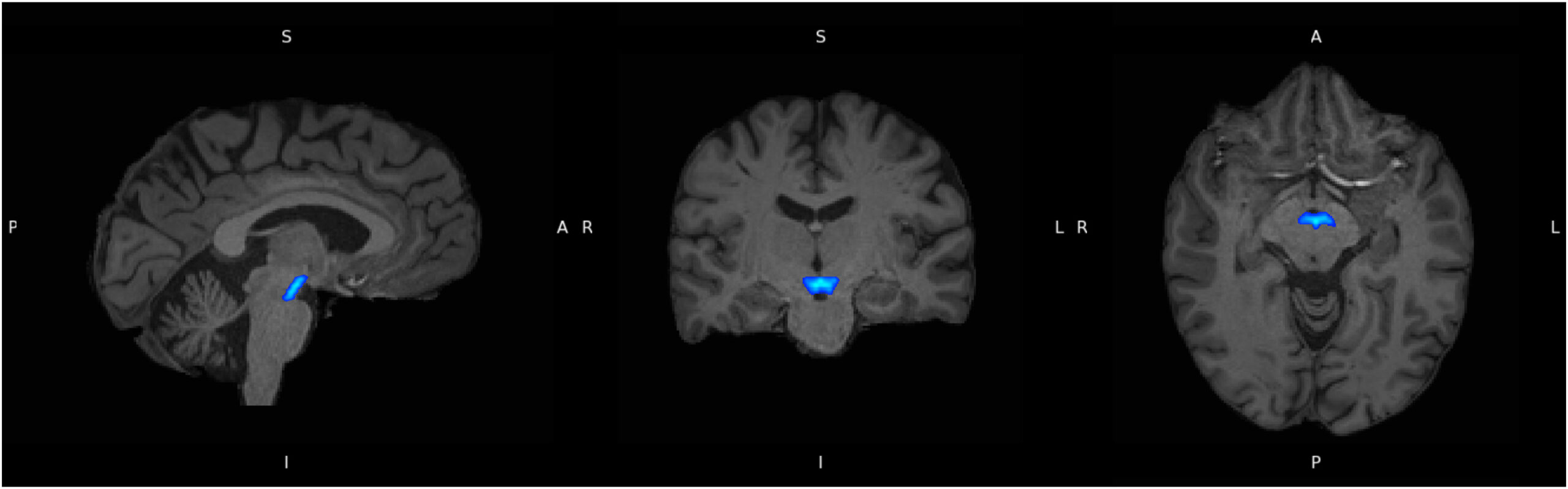 Ventral tegmental area (in blue), delineated using the Levinson-Bari Limbic Brainstem Atlas, displayed on coregistered participant T1 images. A, anterior; I, inferior; L, left; P, posterior; R, right; S, superior.