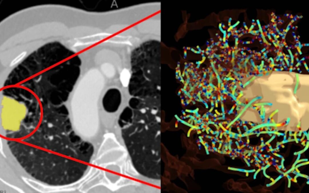 Tumor Vasculature has Long Been a Target. Measuring it is the Next Step